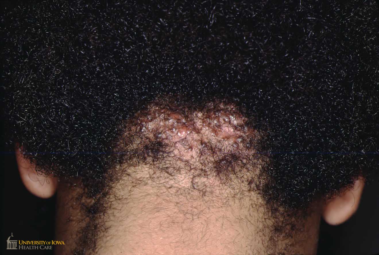 Grouped keloidal papules on the occipital scalp with associated scarring alopecia. (click images for higher resolution).