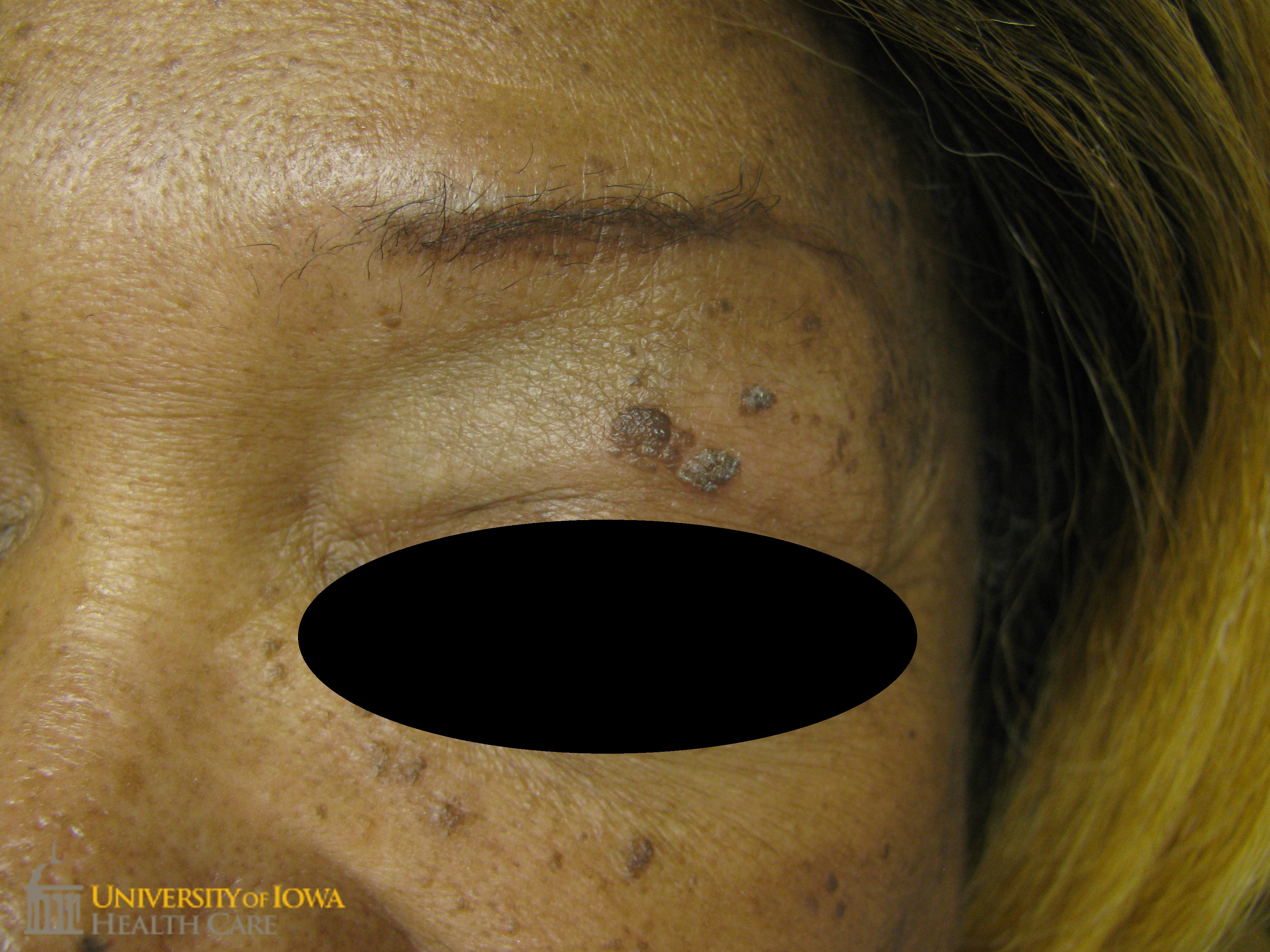 Verrucous brown stuck-on papules on the upper eyelid and cheeks. (click images for higher resolution).