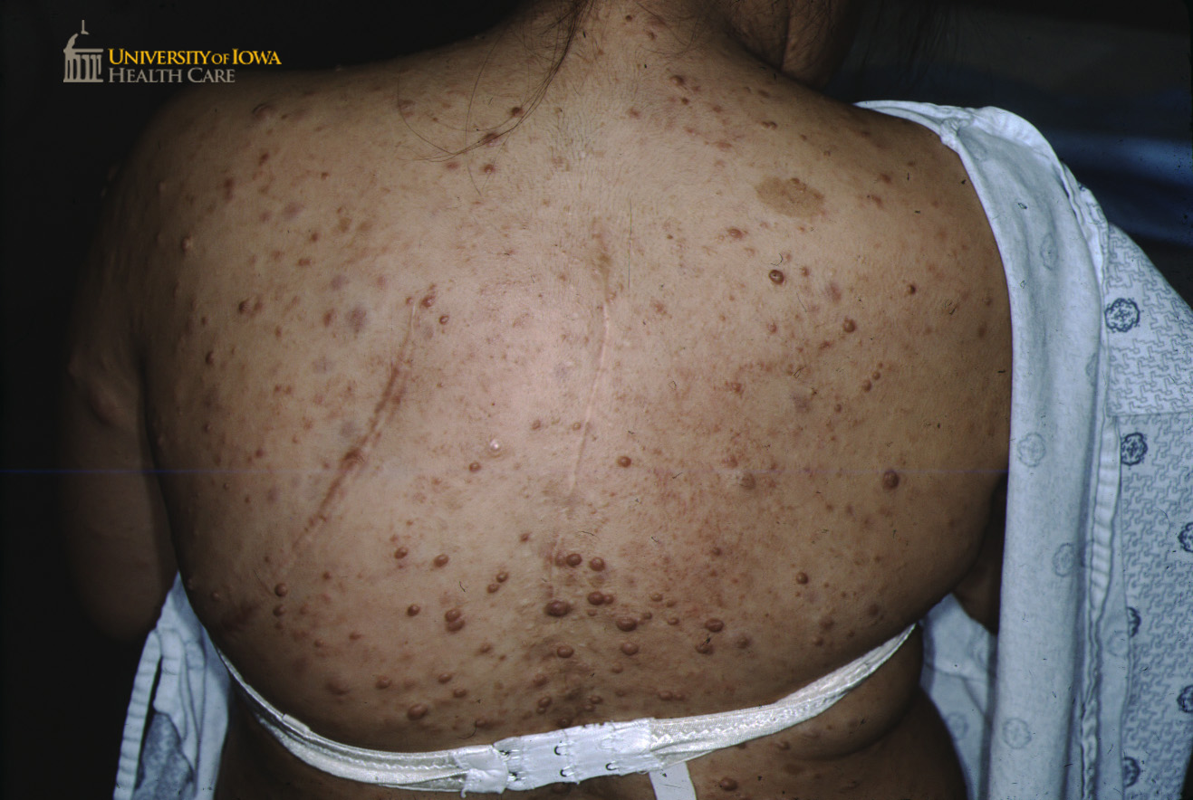Many neurofibromas of varying size (brown papules and nodules) and café-au-lait macules (brown patches) on the back. (click images for higher resolution).