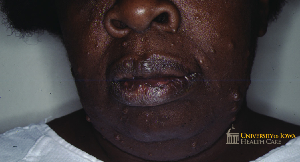 Many skin-colored papules and nodule son the face. (click images for higher resolution).