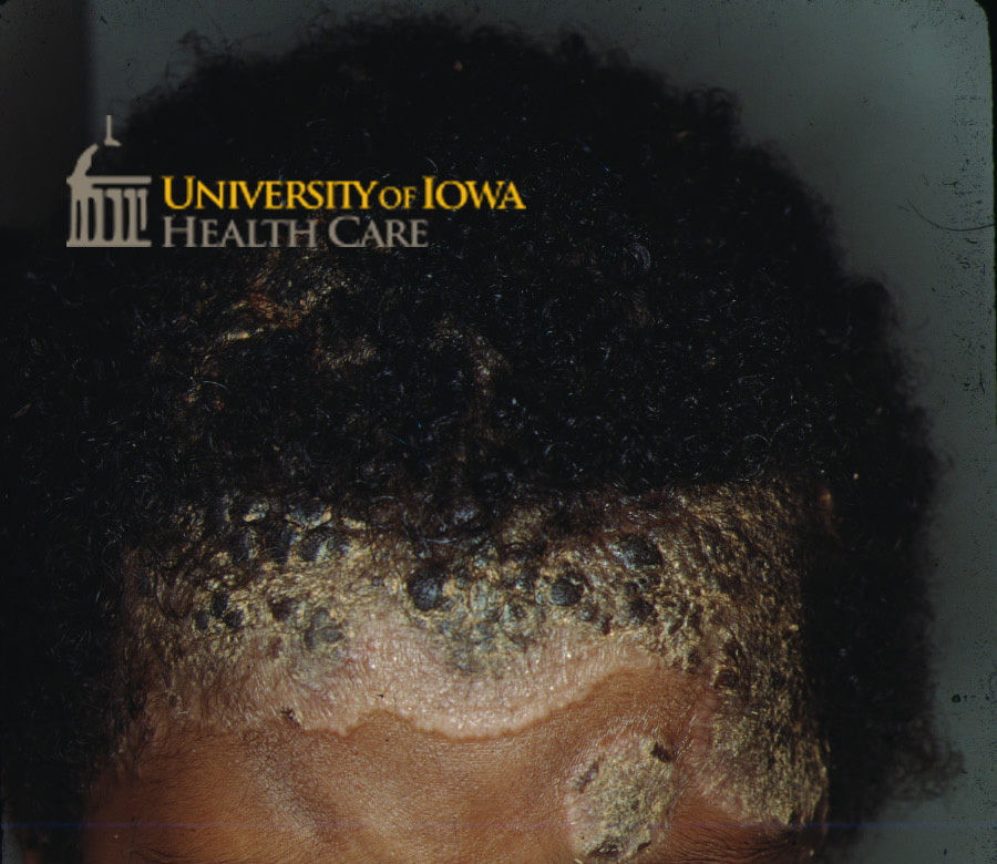 Hyperkeratotic yellow plaques, some with hemorrhaging crusting, on the scalp, nose, and forehead. (click images for higher resolution).