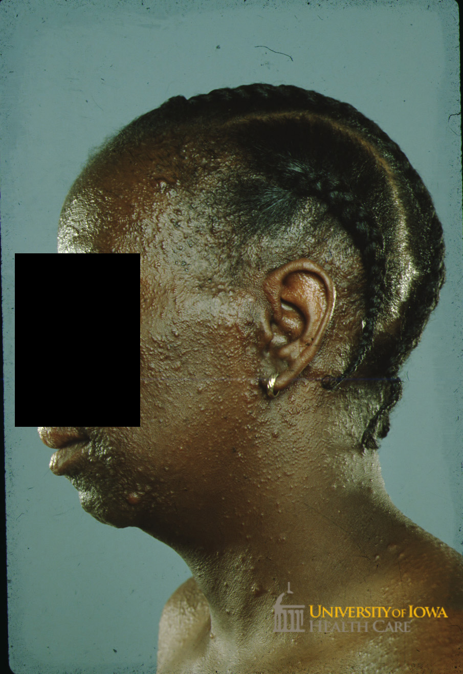 Diffuse skin-colored to pink papules and nodules on the face and neck. (click images for higher resolution).