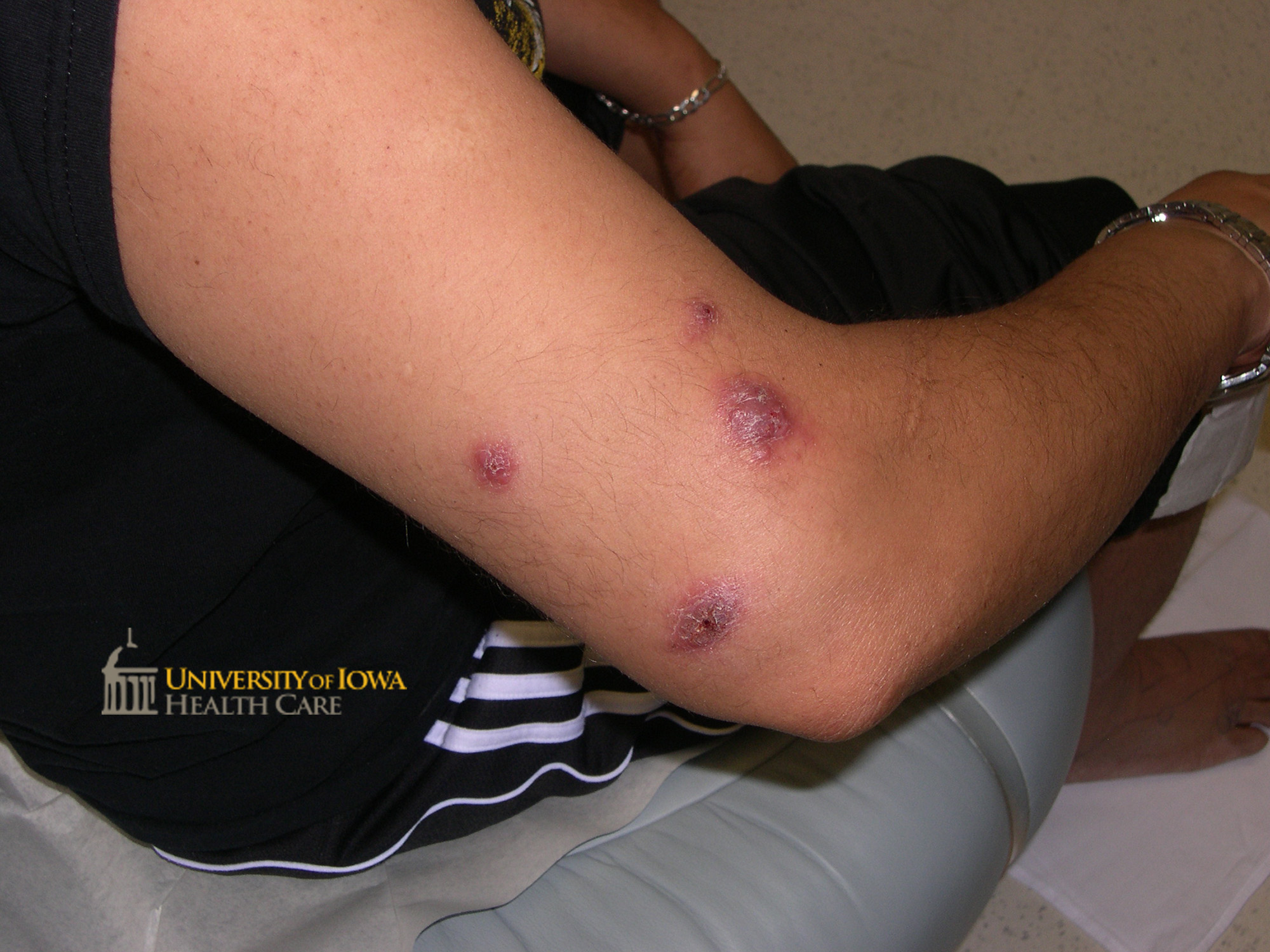 Multiple, deep pink shiny plaques with irregular surface on the lateral arm . (click images for higher resolution).