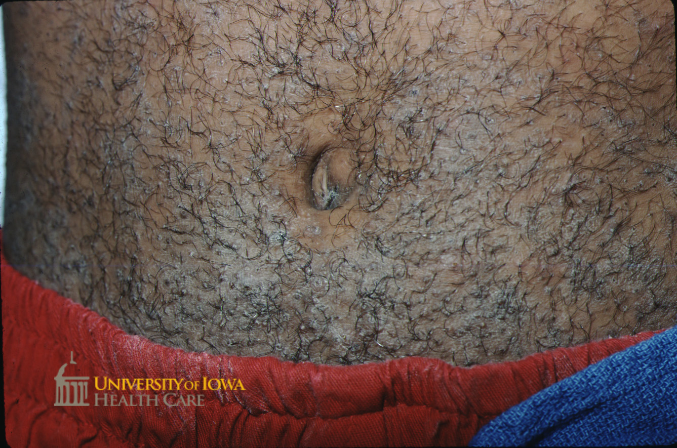 Hyperpigmented papules with surrounding scaling on the lower abdomen. (click images for higher resolution).