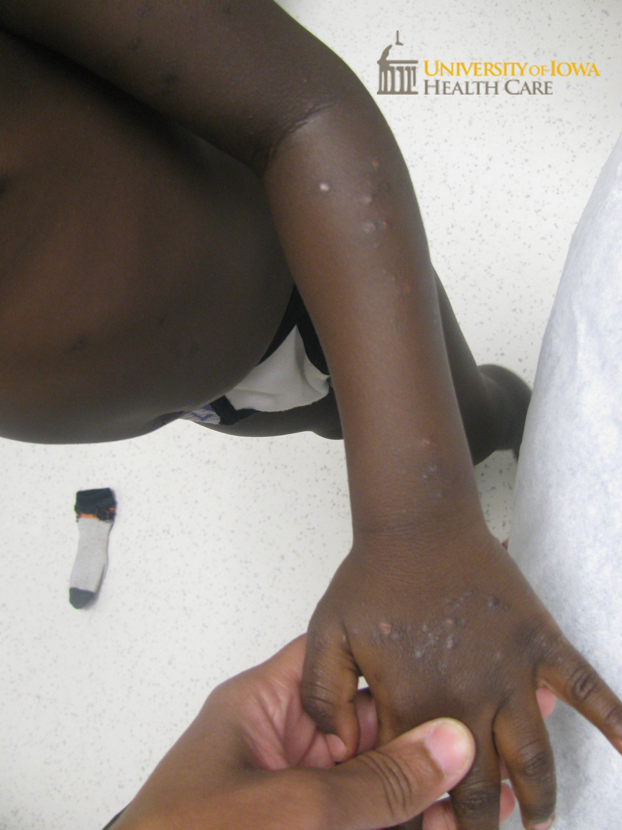 Hyperpigmented scaly grouped papules, some with focal erosions, on the ...