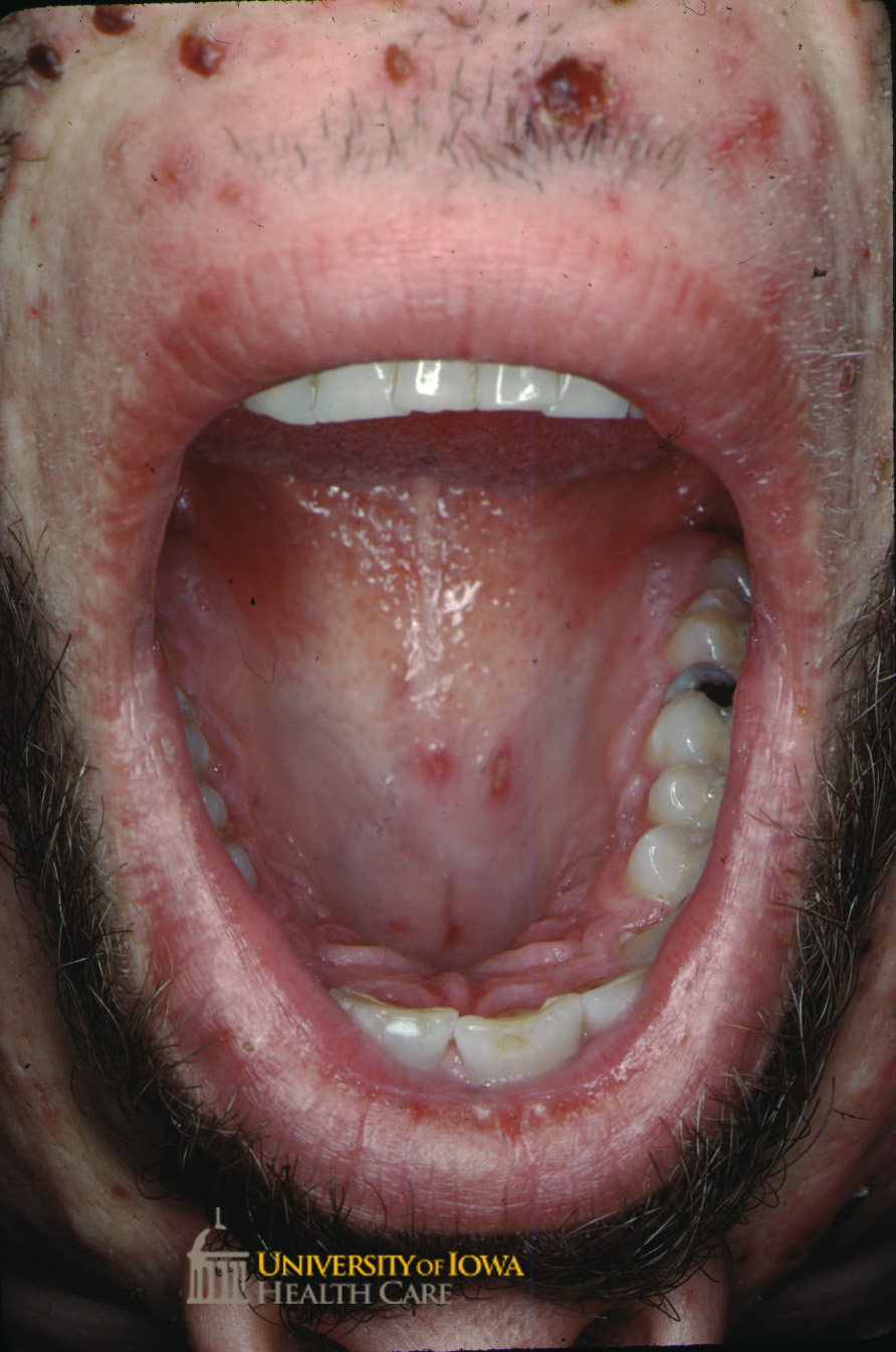 Crusted papules on the face with papules with central erosion on the oral mucosa. (click images for higher resolution).