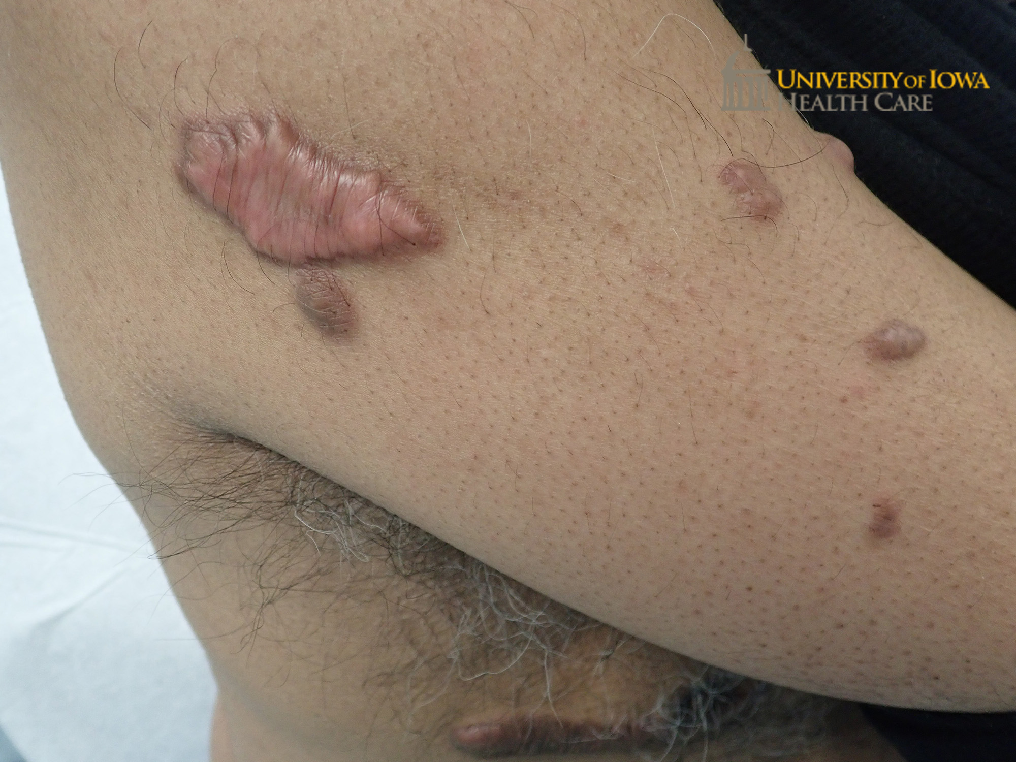 Pink to hyperpigmented papules and linear plaques on the lateral arm and trunk. (click images for higher resolution).