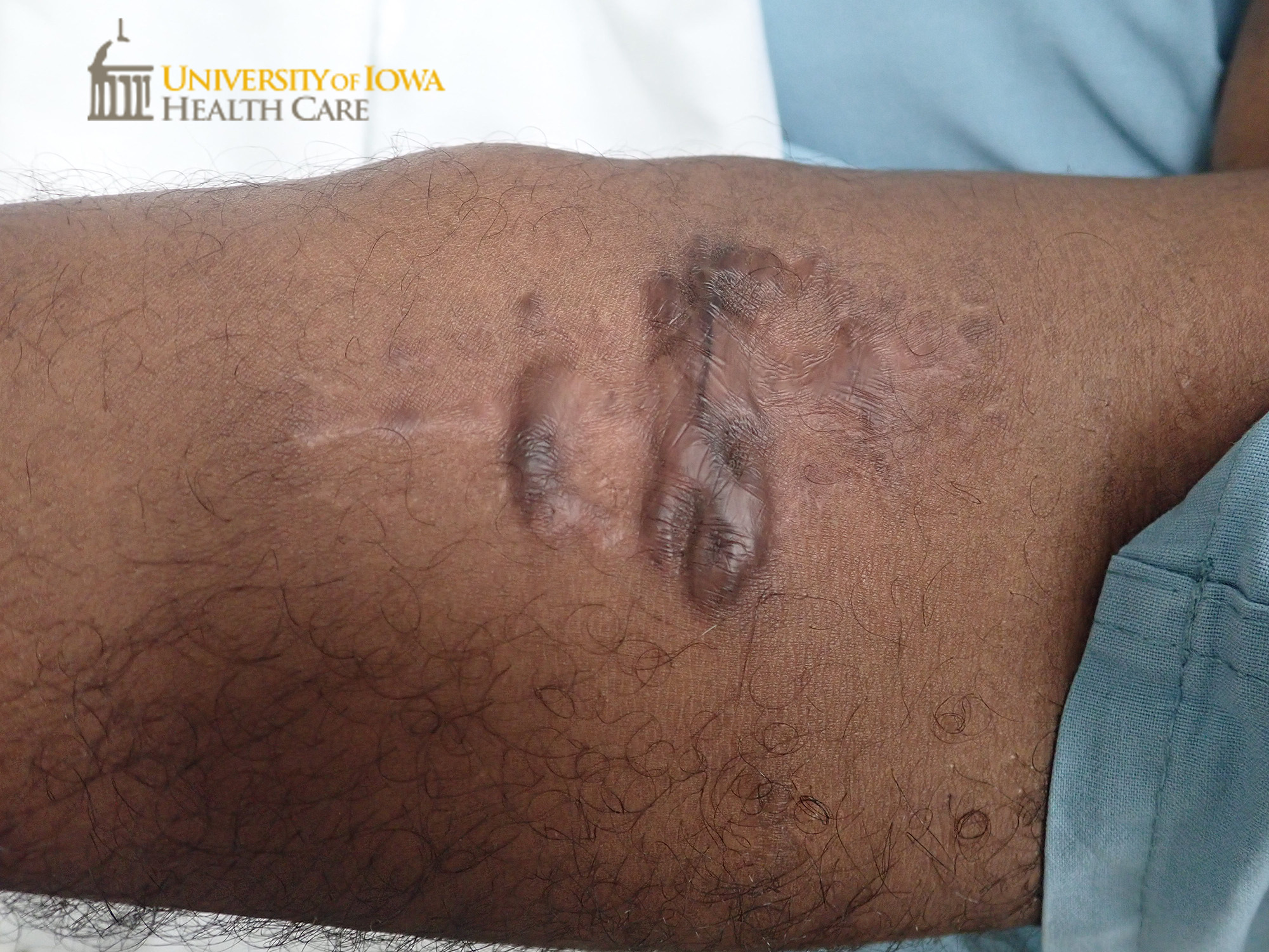 Pink to hyperpigmented linear plaques at site of surgical incision. (click images for higher resolution).