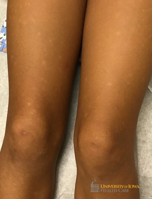 Hypopigmented papules and macules on the lower extremities. (click images for higher resolution).