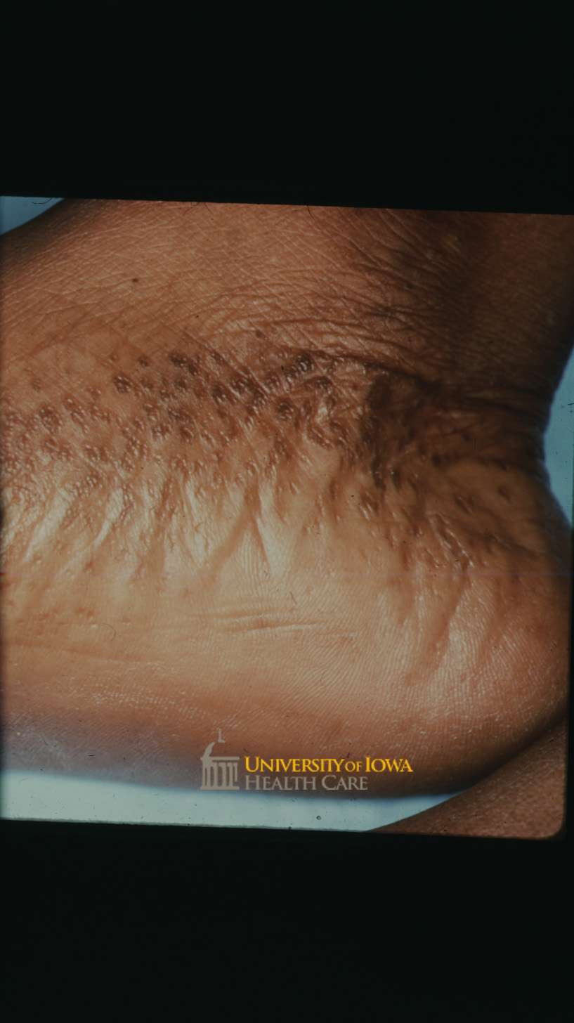 Punctate hyperpigmented pits within a hyperkeratotic plaque on the medial foot. (click images for higher resolution).