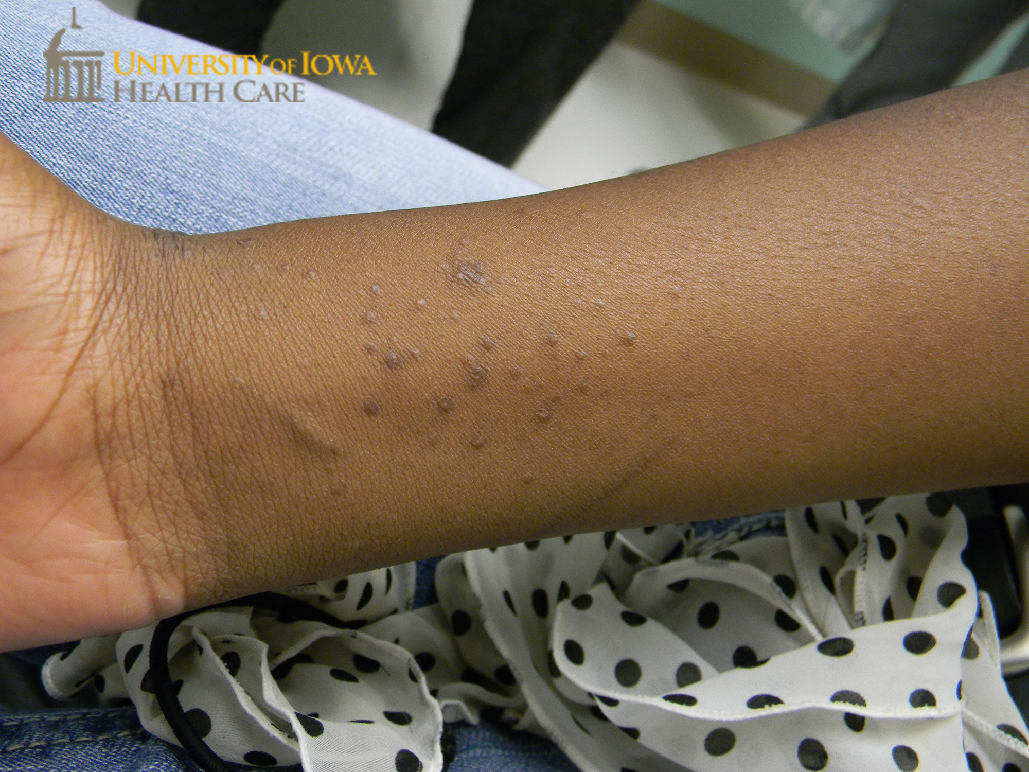 Hyperpigmented monomorphic papules on the arms. (click images for ...