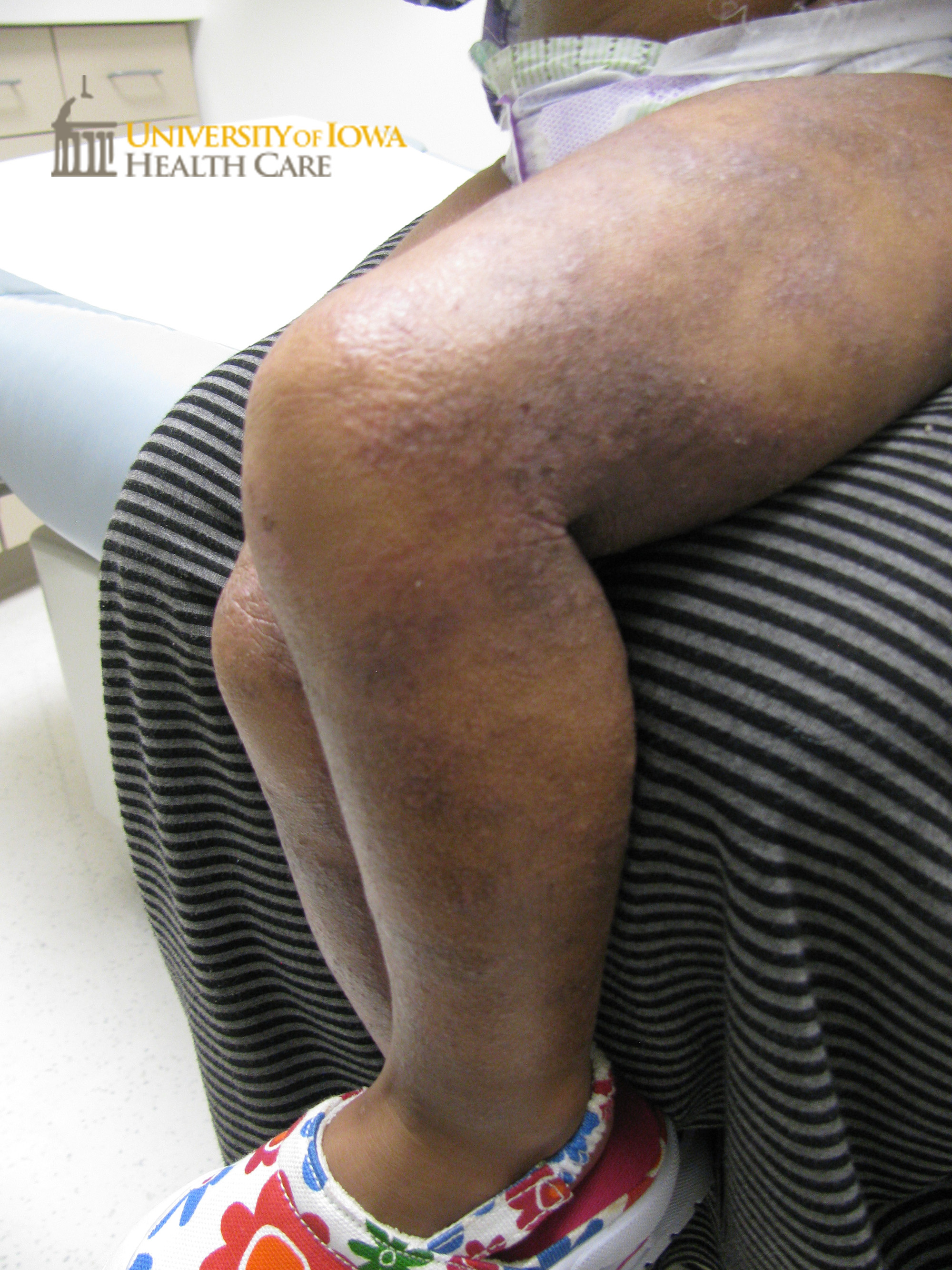 Hyperpigmented to erythematous lichenified scaly plaques on the thigh ...