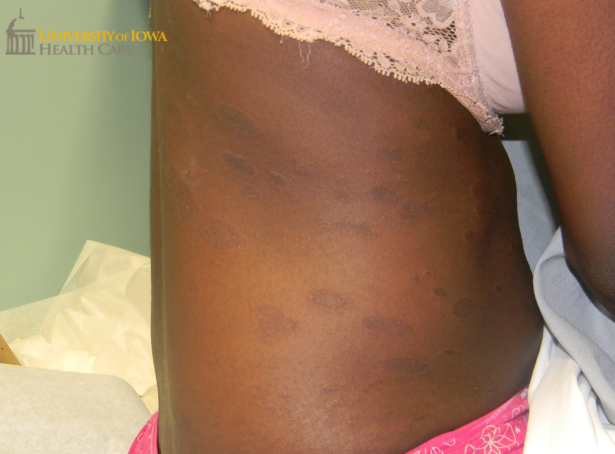 Fig 2. Ovoid gray-brown papules and plaques with fine scale. (Click ...