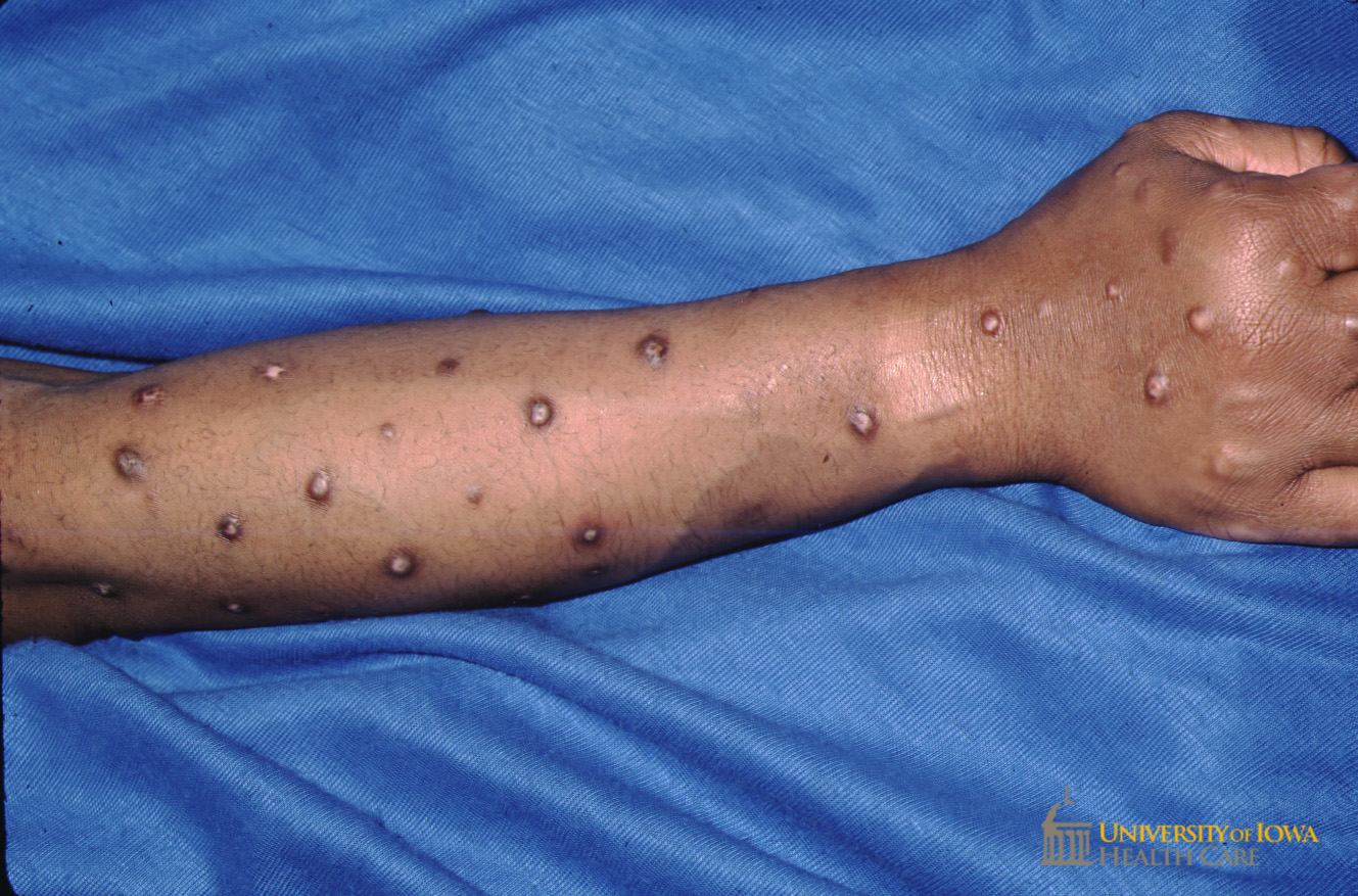 Multiple crusted hypopigmened nodules and plaques with rim of hyperpigmentation on the arm. (click images for higher resolution).