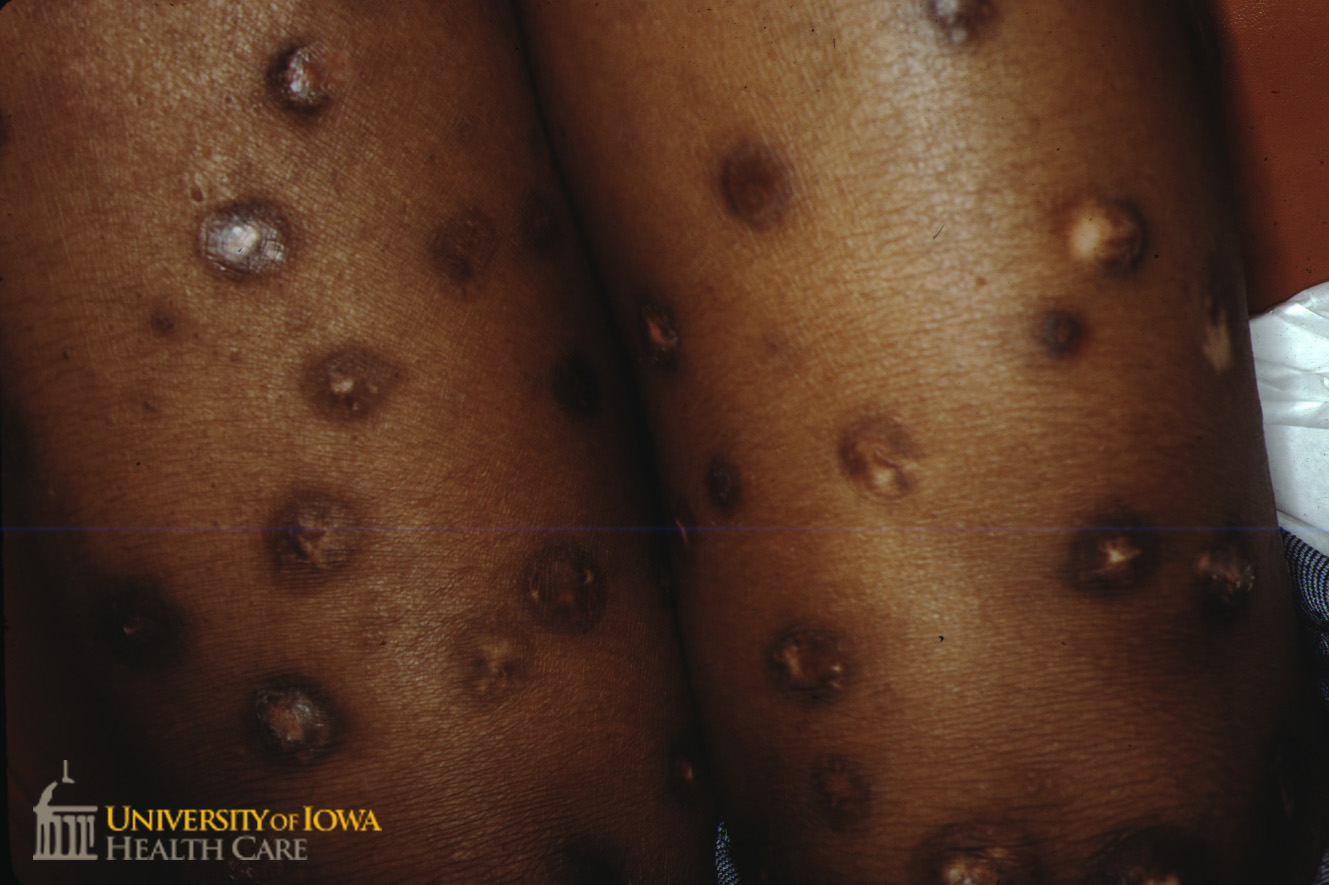 Multiple crusted hypopigmened nodules with rim of hyperpigmentation on the legs. (click images for higher resolution).