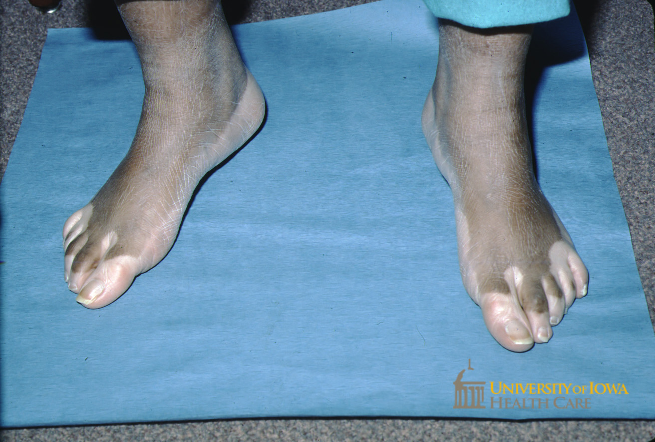 Depigmented patches on the plantar foot and dorsal toes. (click images for higher resolution).