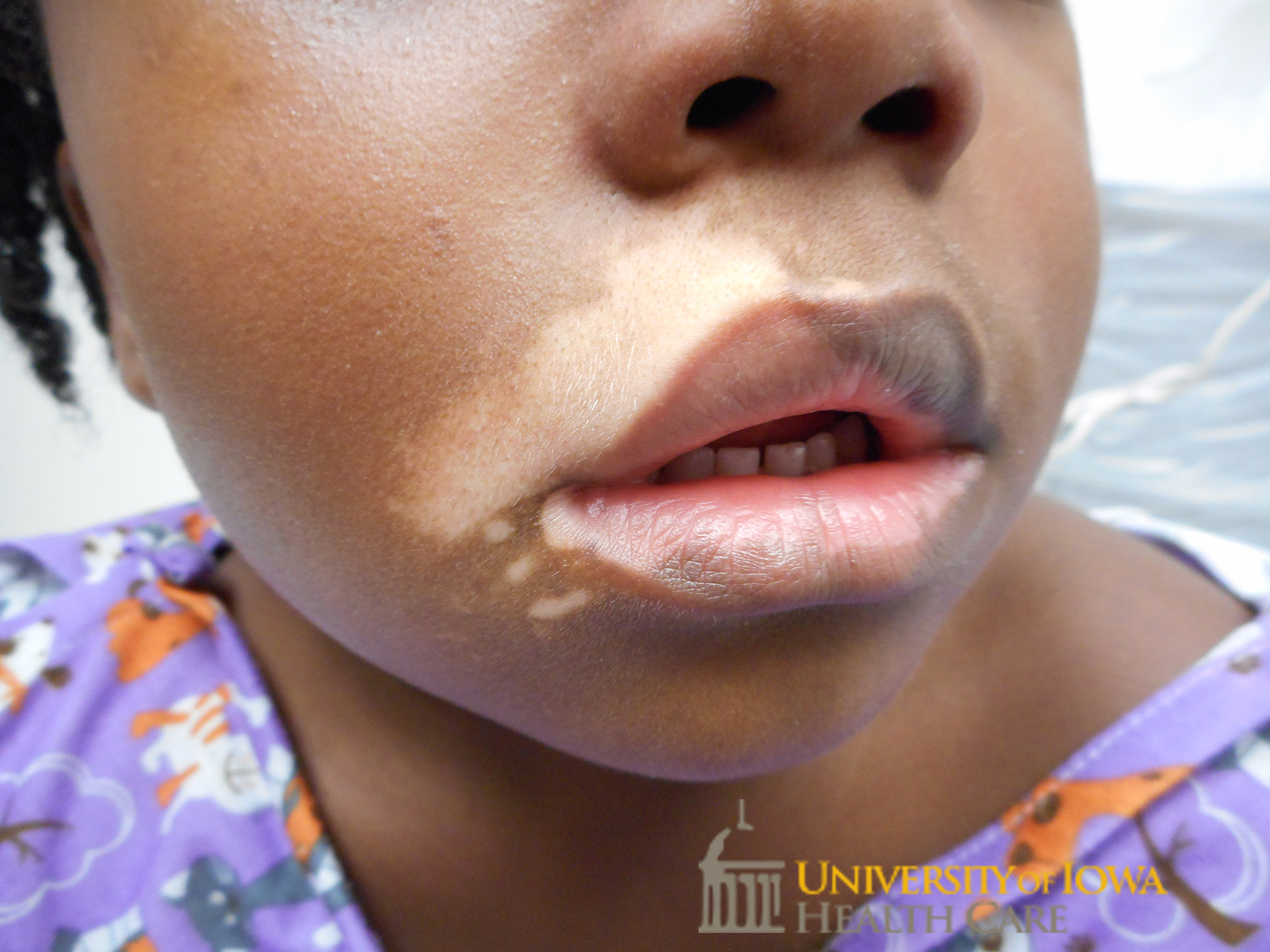 Depigmented patches on the vermillion lip extending to the cutaneous lip and cheek. (click images for higher resolution).