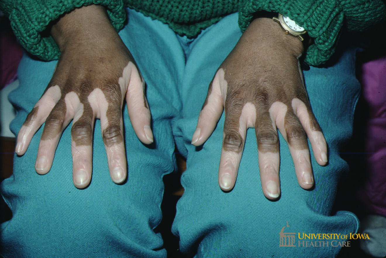 Depigmented patches on the dorsal hands and fingers. (click images for higher resolution).