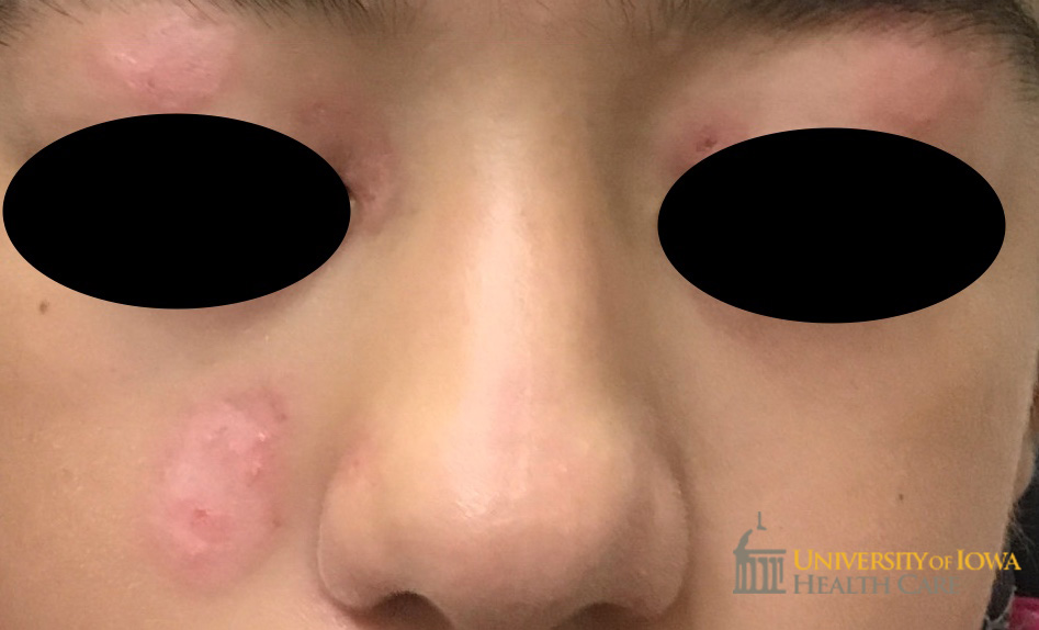 Well demarcated pink, shiny, and atrophic plaque on the cheeks and upper eyelid. (click images for higher resolution).