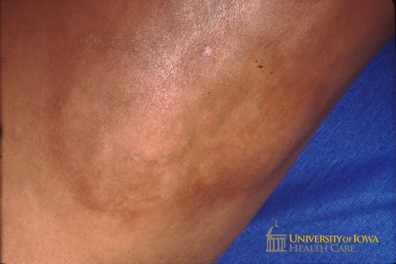 Faint, shiny, hypo- and hyperpigmented plaque with adjacent erythema on the extremity. (click images for higher resolution).