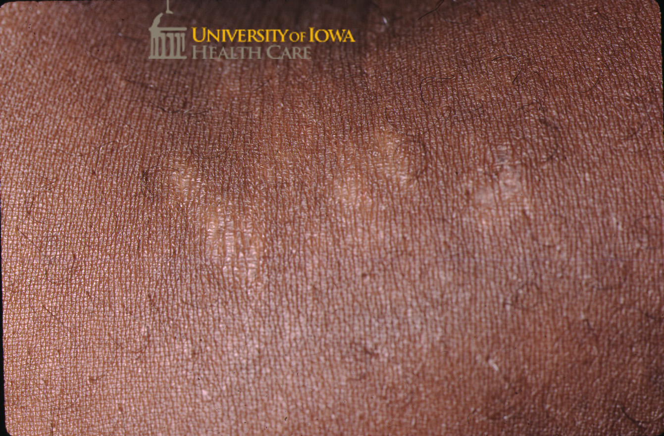 Hypopigmented to to pink papules. (click images for higher resolution).