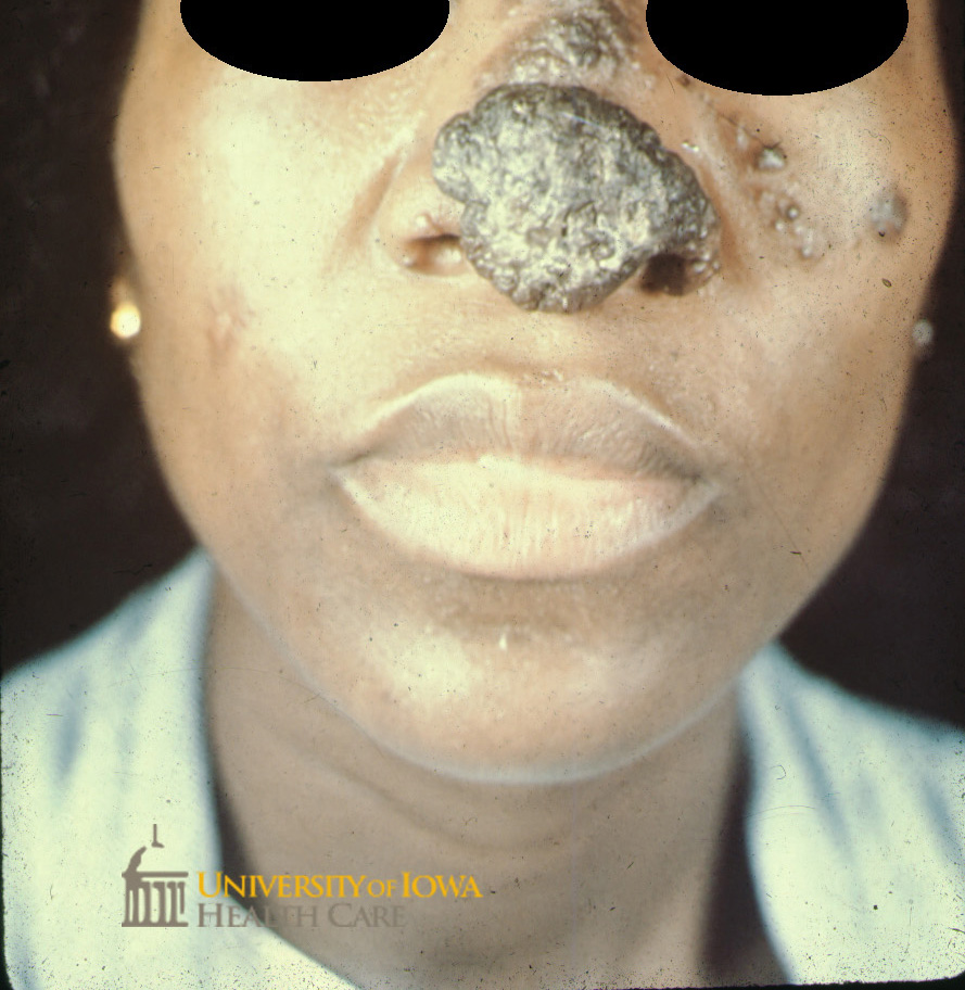 Gray to violaceous verrucous nodule, papules, and plaques on the nose and cheek. (click images for higher resolution).
