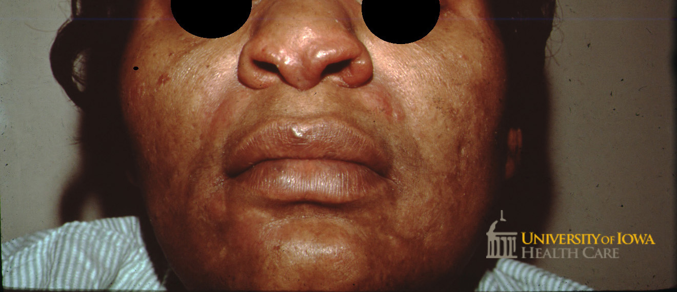 Red-brown papules and plaques on the nose and periorbital cheek. (click images for higher resolution).