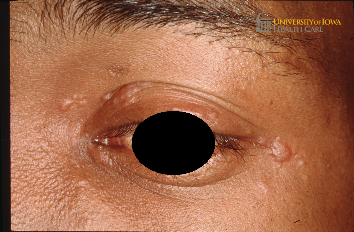 Pink papules on the eyelids and cheeks. (click images for higher resolution).