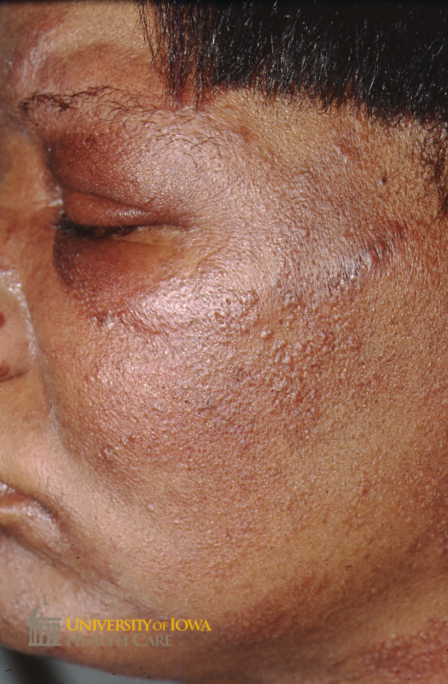 Red-brown papules on the cheek, nose, and neck. (click images for higher resolution).