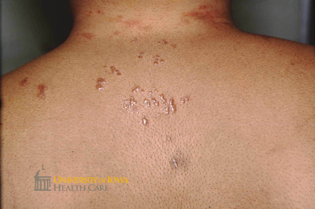 Red-brown papules on the back. (click images for higher resolution).