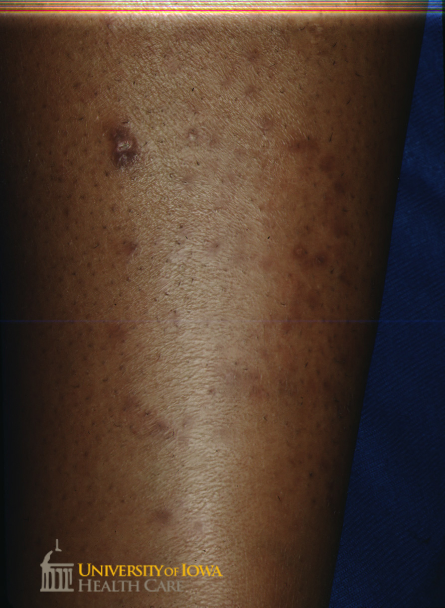 Red-brown papules on the lower leg. (click images for higher resolution).