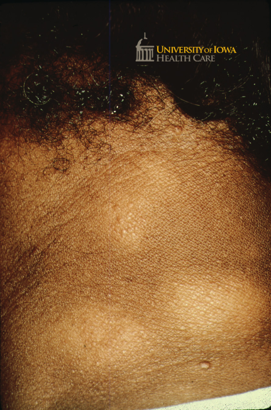 Hypopigmented plaques on the posterior neck. (click images for higher resolution).