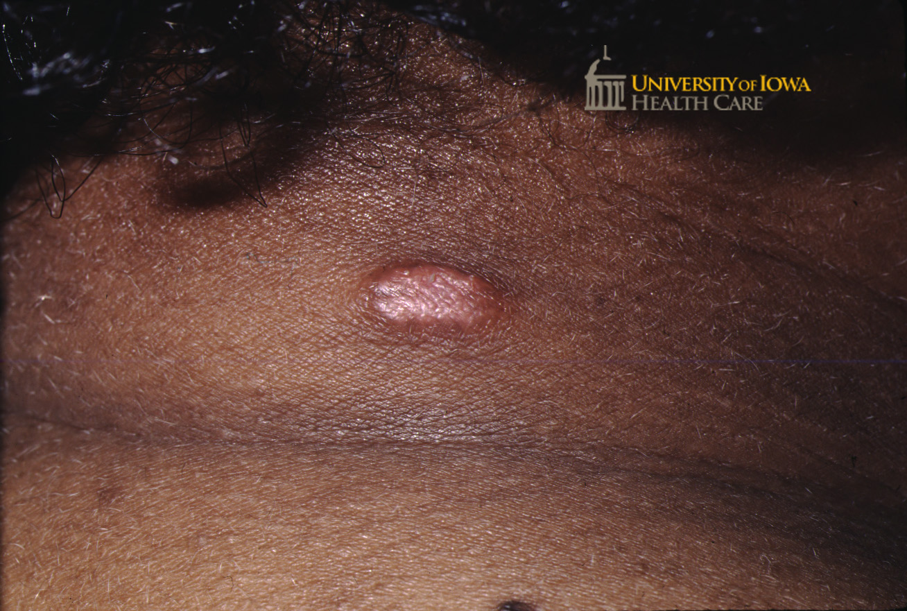 Pink plaque on the posterior neck. (click images for higher resolution).
