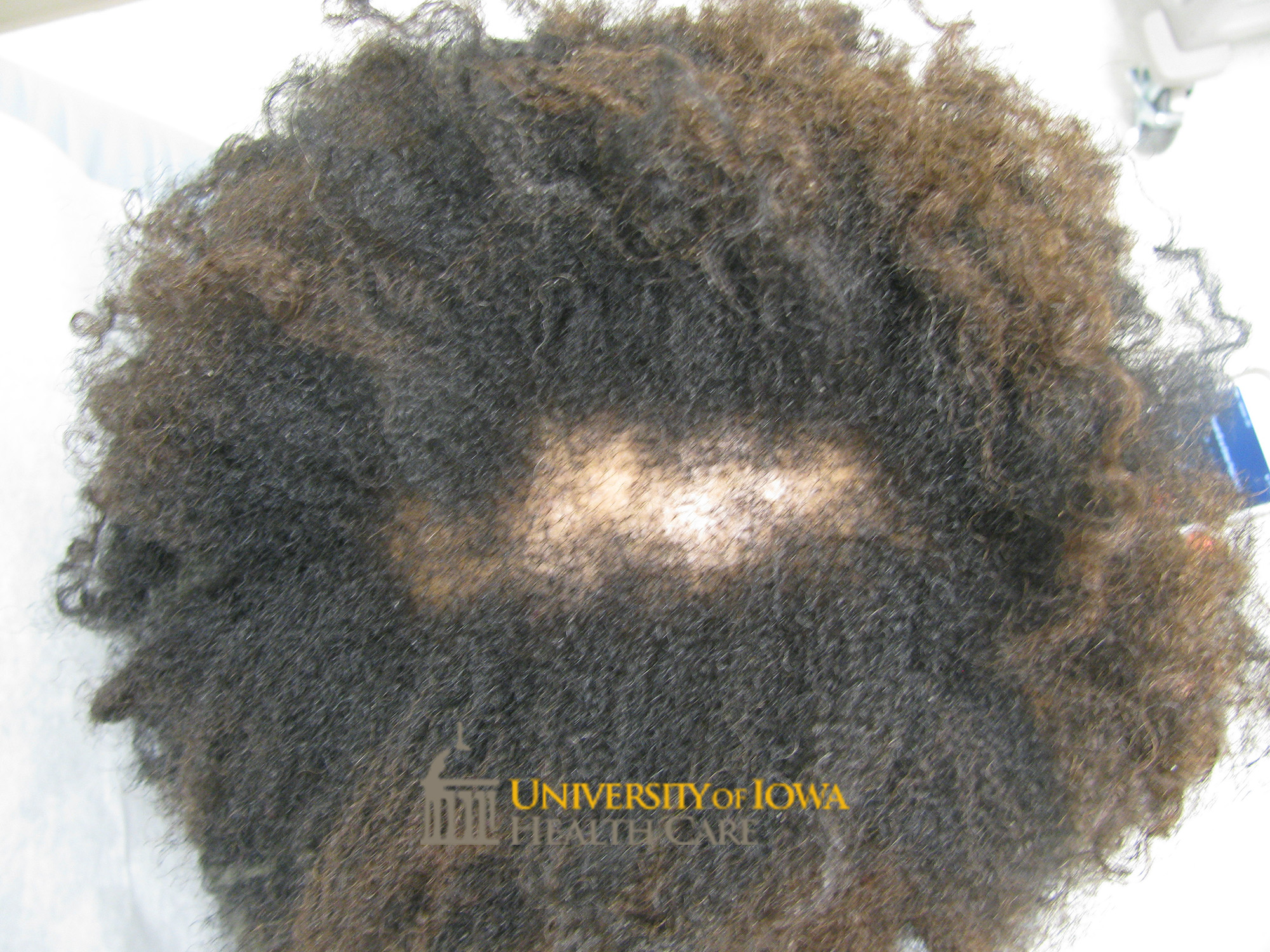Patch of scarring alopecia with irregular borders on the scalp. (click images for higher resolution).