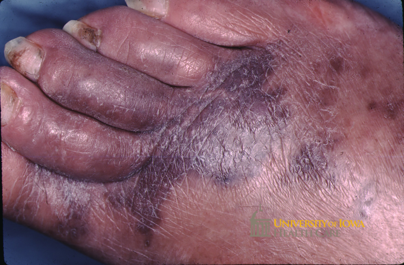 Maroon plaque on the dorsal foot and toes. (click images for higher resolution).