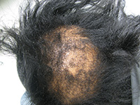 Central centrifugal cicatricial alopecia