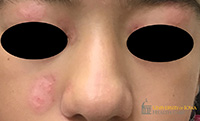 Discoid lupus erythematosus