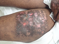 Dystrophic Epidermolysis Bullosa