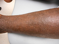 Atopic dermatitis