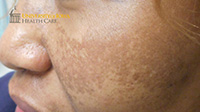 Melasma