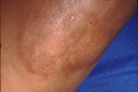 morphea