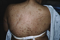 Neurofibromatosis