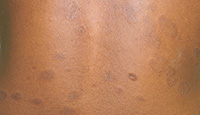 Pityriasis Rosea