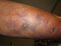 Calciphylaxis