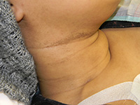 Cyclophosphamide induced flexural pigmentation