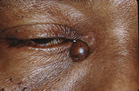 Epidermal inclusion cyst