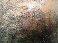 Folliculitis Decalvans