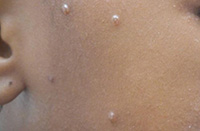 Molluscum contagiosum