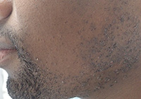 Pseudofolliculitis barbae